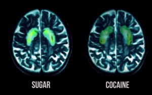 sugar cocaine brain PET scan